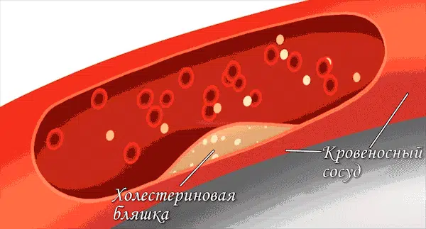 Закупорка сосудов